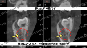 CT画像で神経との位置関係がわかりました